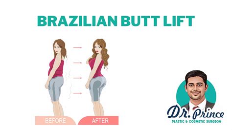 Best Brazilian Butt Lift (BBL) San Antonio, TX 